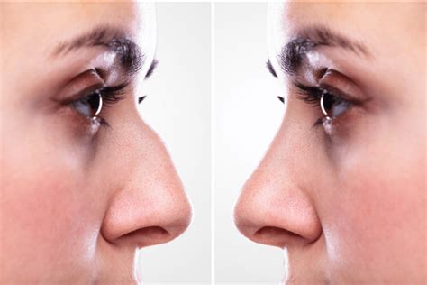 Rhinoplasty Lokman Hekim Health Group