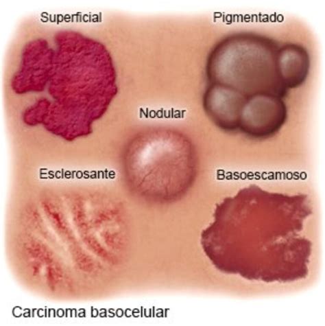 Carcinoma De Células Basales Diagnóstico Y Abordaje Cio Salud