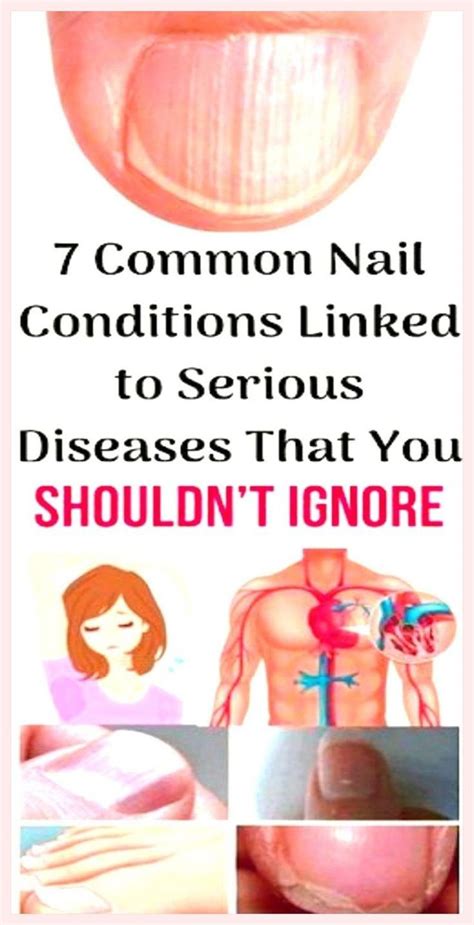 7 Common Nail Conditions Linked To Serious Diseases That You Shouldn’t Ignore White Nail Beds