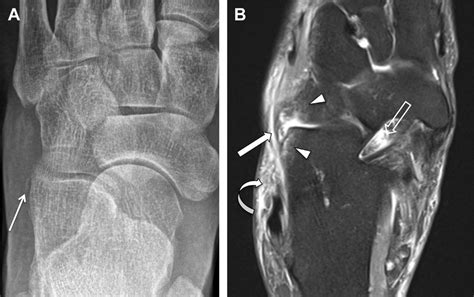 Partial Chopart Injury With Lateral Column Disruption In A Year Old