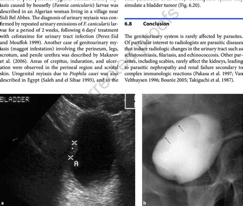 20 Eosinophilic cystitis. a Ultrasound examination of the bladder... | Download Scientific Diagram