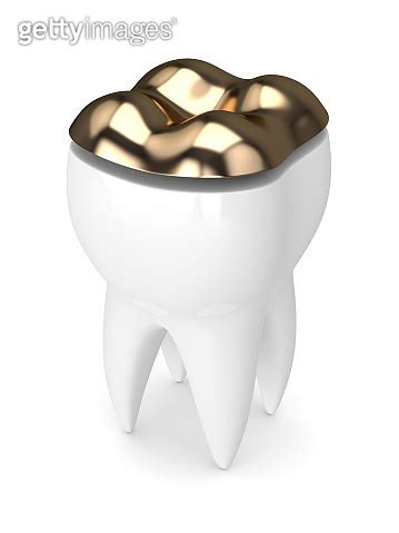 3d render of tooth with dental golden onlay filling 921763940 게티이미지뱅크