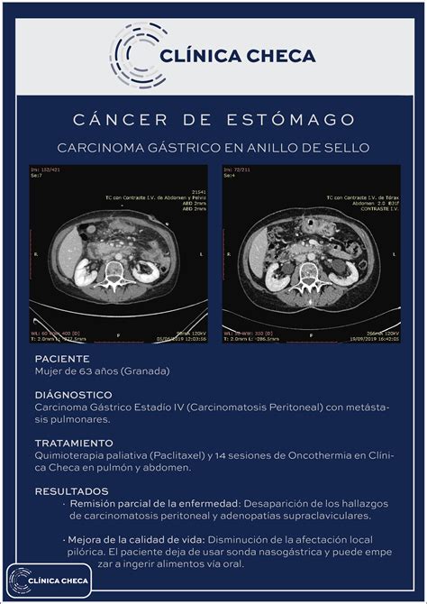 Cáncer de estómago - CLÍNICA CHECA