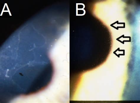 Figure A Epithelial Basement Membrane Corneal StatPearls