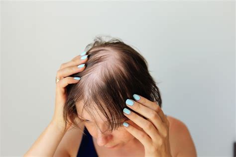 Understanding Androgenetic Alopecia In Women Svenson