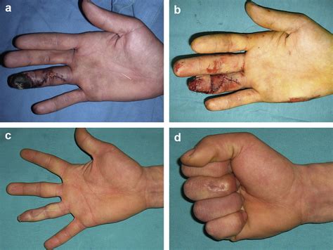 High Pressure Paint Gun ınjection ınjury Of The Hand A Case Report Journal Of Plastic