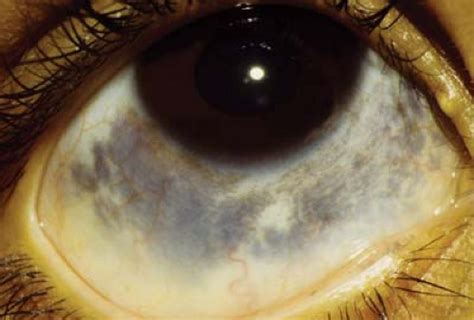 Conjunctiva Ento Key