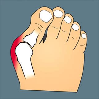 Hallux Valgus Oignon Pied D Finition Traitement Op Ration