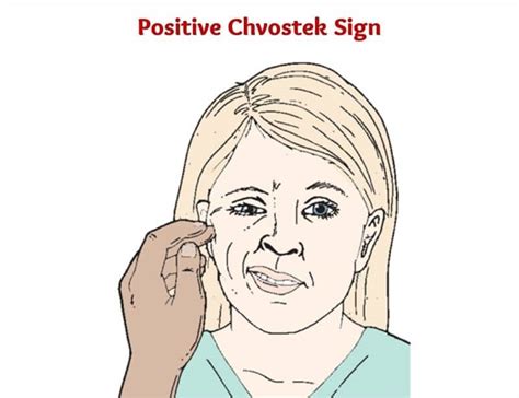 Chvostek Sign Positive Chvostek Sign Causes Assessment