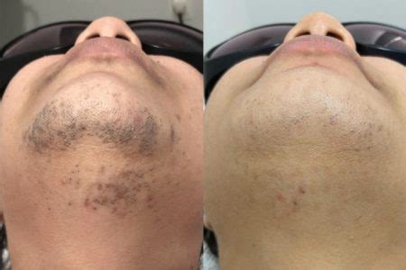 Depila O A Laser Antes E Depois