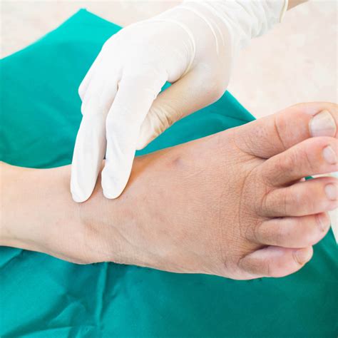 Charcot Foot In Diabetes