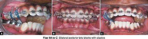 Correction of unilateral scissor bite using Periodontally Accelerated Osteogenic Orthodontics ...