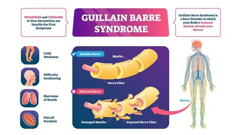 Guillain Barr Syndrome Treatment Propel Physiotherapy