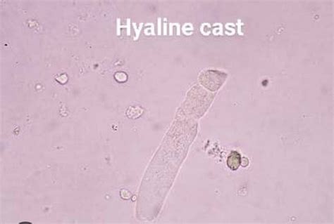 Urinary Casts-overview - Clinical Laboratory Guide