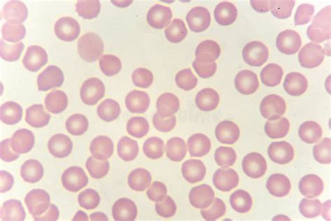 Red Blood Cells in Blood Smear Stock Image - Image of pathology ...