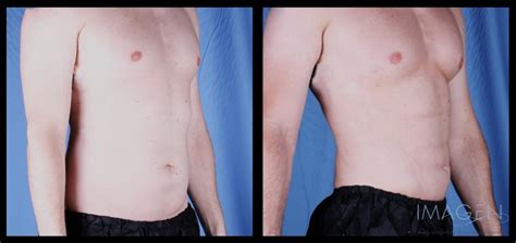 4d Hi Def Liposuction Before And After Omaha Cosmetic Surgery