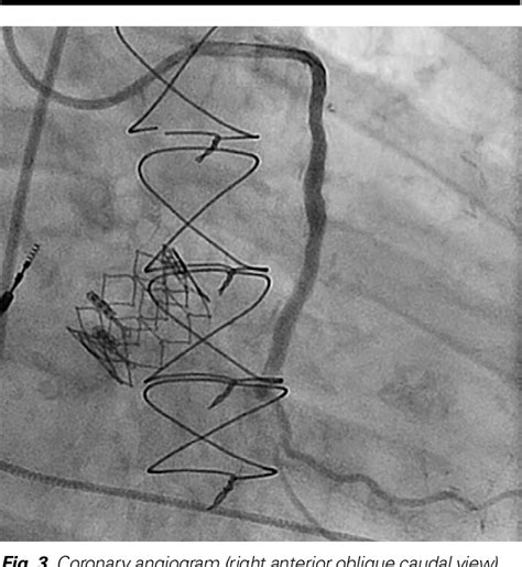 Figure 3 From Orbital Atherectomy And Heavily Calcified Saphenous Vein