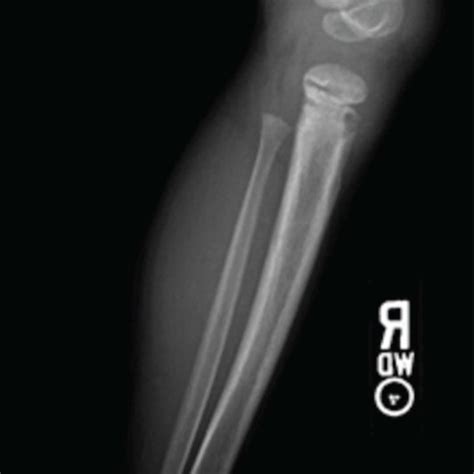 Anteroposterior A And Lateral B Plain Radiographs Of The Patient Download Scientific