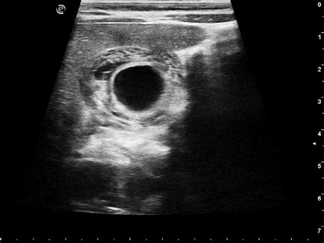 Acute Acalculous Cholecystitis Image Radiopaedia Org