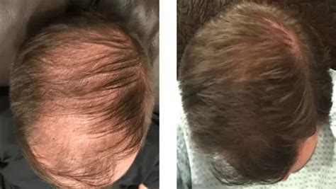 Minoxidil Before And After Photos [2022] Is It Right For You