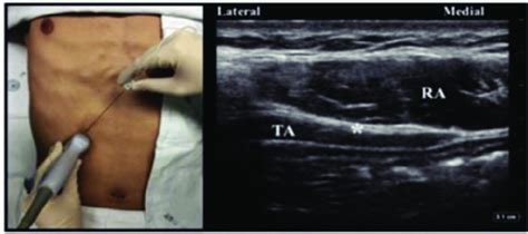 Transversus Abdominis Plane Block Subcostal Approach [11] Download Scientific Diagram