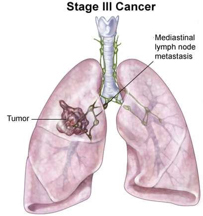 Prognosis Stage 3 Lung Cancer Lymph Nodes - CancerWalls