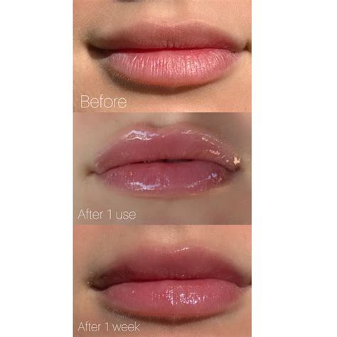 Tratamiento de relleno de labios con infusión de péptidos múltiples