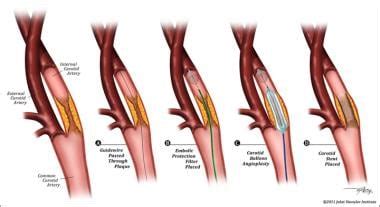 Carotid Artery Stenting Technique Approach Considerations Carotid