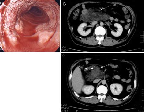 A Gastrointestinal Endoscopy Revealed Bleeding At The Duodenum B Download Scientific Diagram