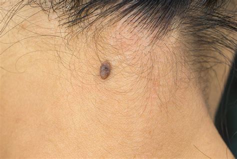 Melanoma On Scalp Pictures Early Stage 1 Scalp Melanoma Images