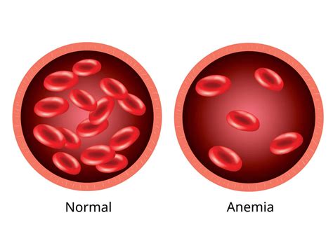 7 señales de alerta de la anemia en niños Mejor con Salud