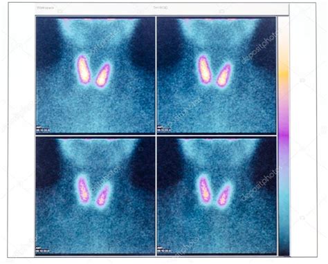 Scintigraphy Of Thyroid Gland With Two Nodule Stock Photo By ©aniphaes