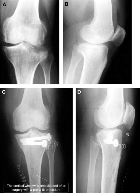 Arthroscopic Treatment Of Lateral Tibial Plateau Fractures A Simple