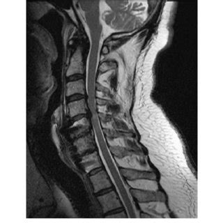 Pre Operative Mid Sagittal T2 Weighted MRI Showing Significant