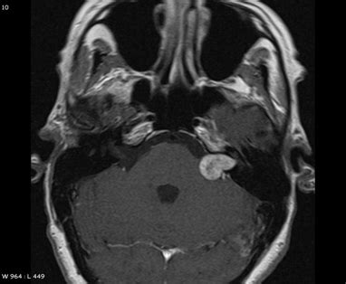 Neurinoma Dellacustico O Schwannoma Vestibolare Maurizio G Vigili