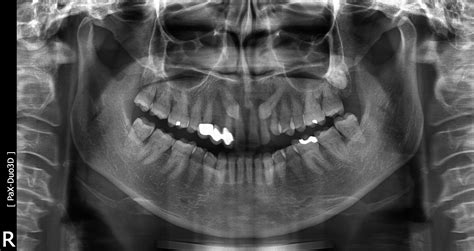 Tac Dental Maxilar Imagen Maxilofacial