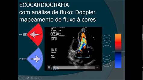 Aula Ecocardiograma Introdu O A Metade Youtube