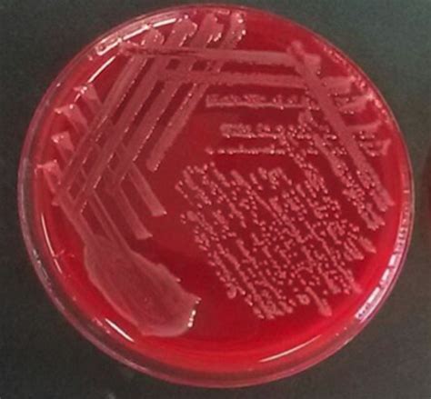 Tubo Ovarian Abscess Infected By Salmonella Typhi BMJ Case Reports