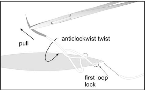 A novel technique in securing the subcuticular suture—“Loop & Lock ...