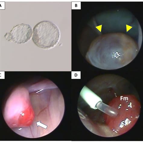 Sperm Injected Into The Uterus Telegraph