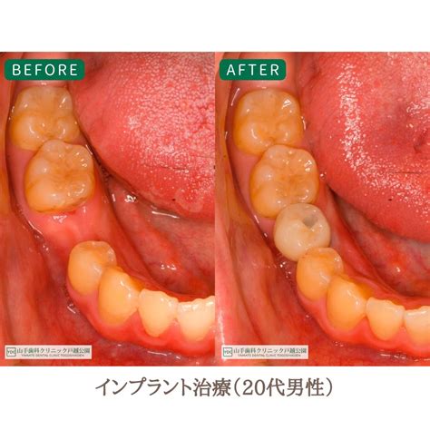 症例紹介8：インプラント治療（20代男性） 東京都品川区 Ydc審美インプラント治療専門ガイド｜山手歯科クリニック大井町・戸越公園