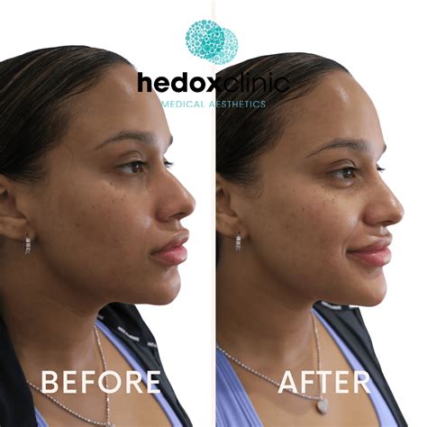 Chin Fillers In London Hedox Clinic Expert Cosmetic Doctors