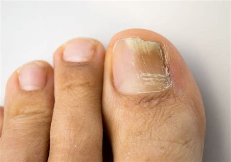 Causes Of Brittle Nails Diamond Skin Care