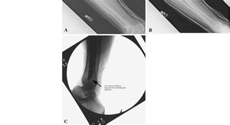 Ac A Lateral And B Anteroposterior Radiographs Show The Ankle With