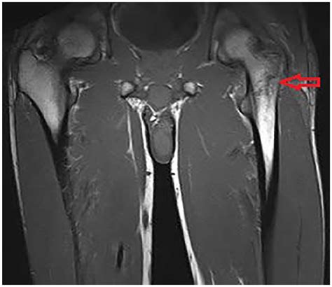 Greater Trochanter Fracture