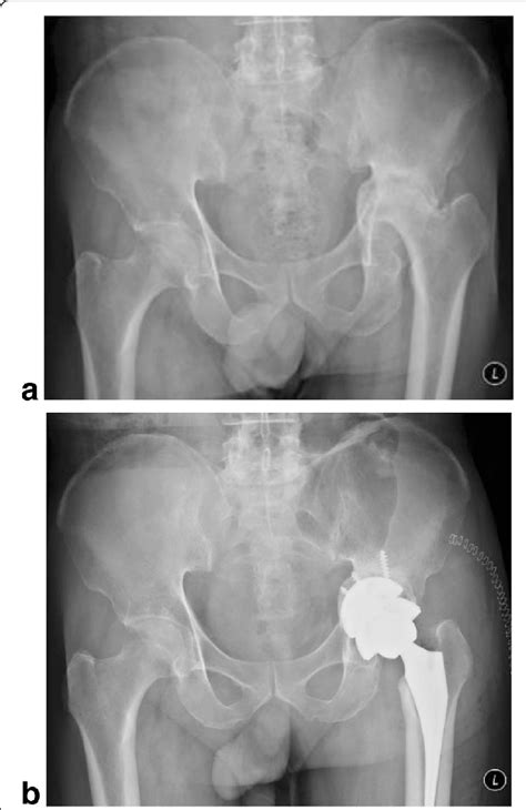 The Picture Shows A Year Old Male Patient With Acetabular Protrusion