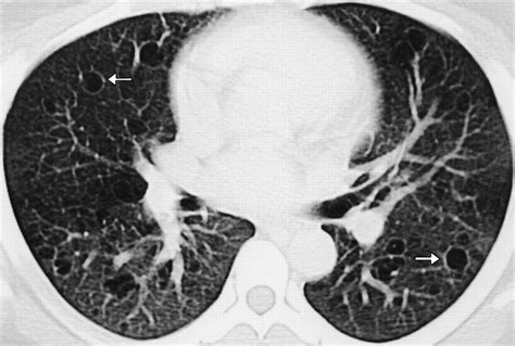 Asthma And Associated Conditions High Resolution Ct And Pathologic