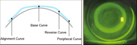 The Evolution Of Orthokeratology Lens Fitting Global Insight