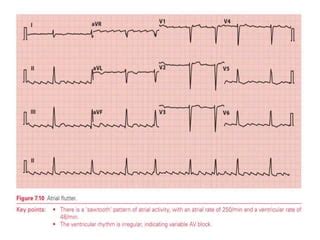 ATRIAL DYSRHYTHMIAS AND HOW TO INTERPRET IN ECG PPT