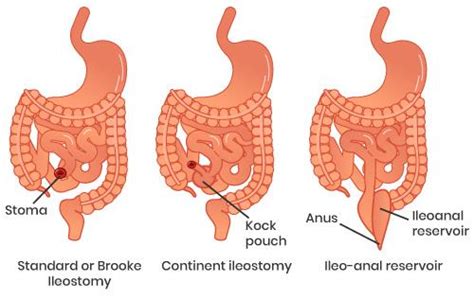 Fandroidtastic: What is Ileostomy? – Ileostomy Care